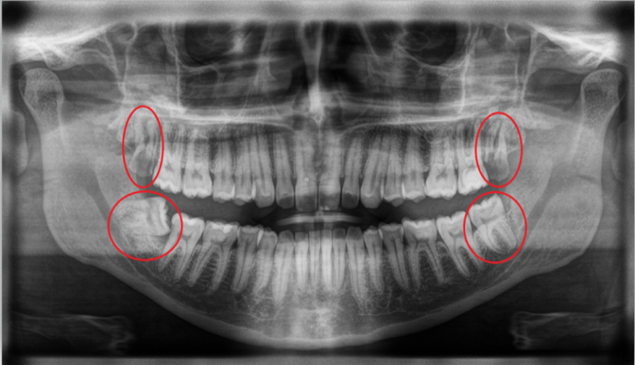 wisdom teeth radiographic view