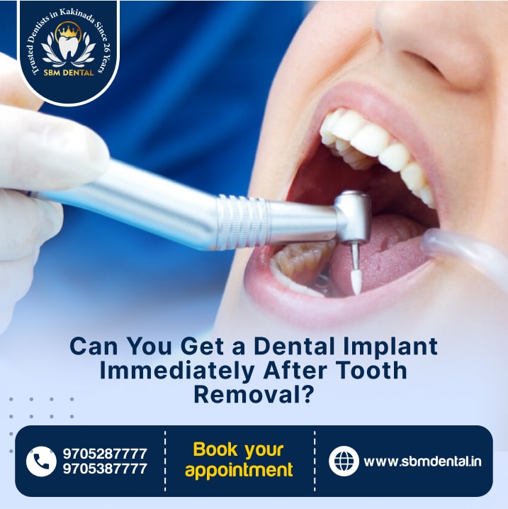 Can You Get a Dental Implant Immediately After Tooth Removal