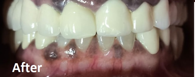 after invisalign treatment