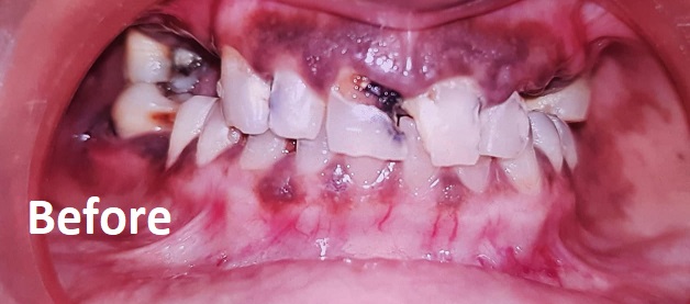 invisalign before treatment