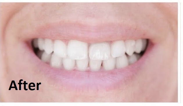 invisalign after treatment