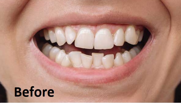 invisalign-before-and-after-crowding