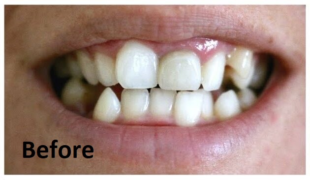 invisalign_before-after_emma_el-paso-tx_dentist-orthodontist-edited