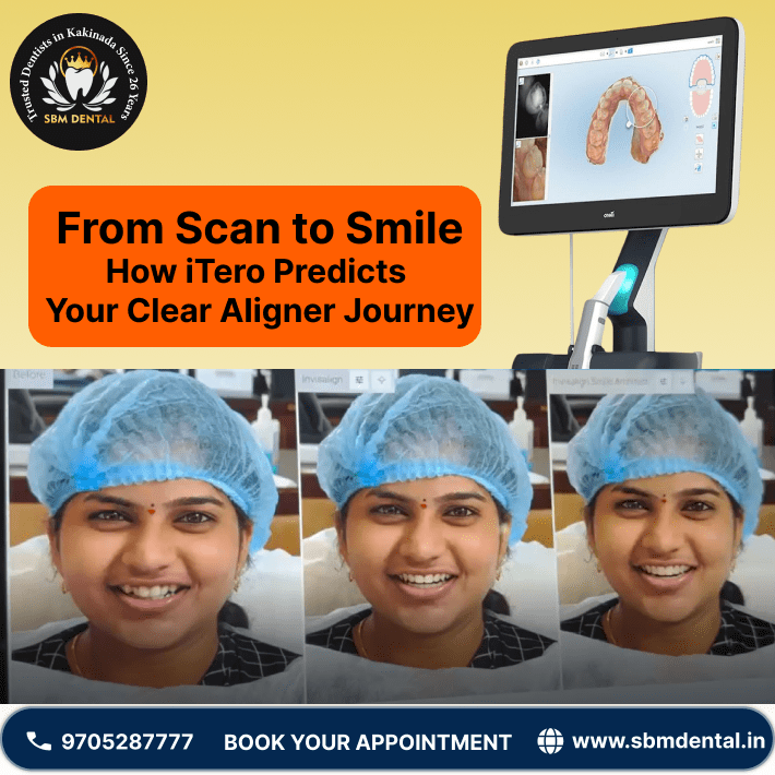 how itero predicts your clear aligner journey