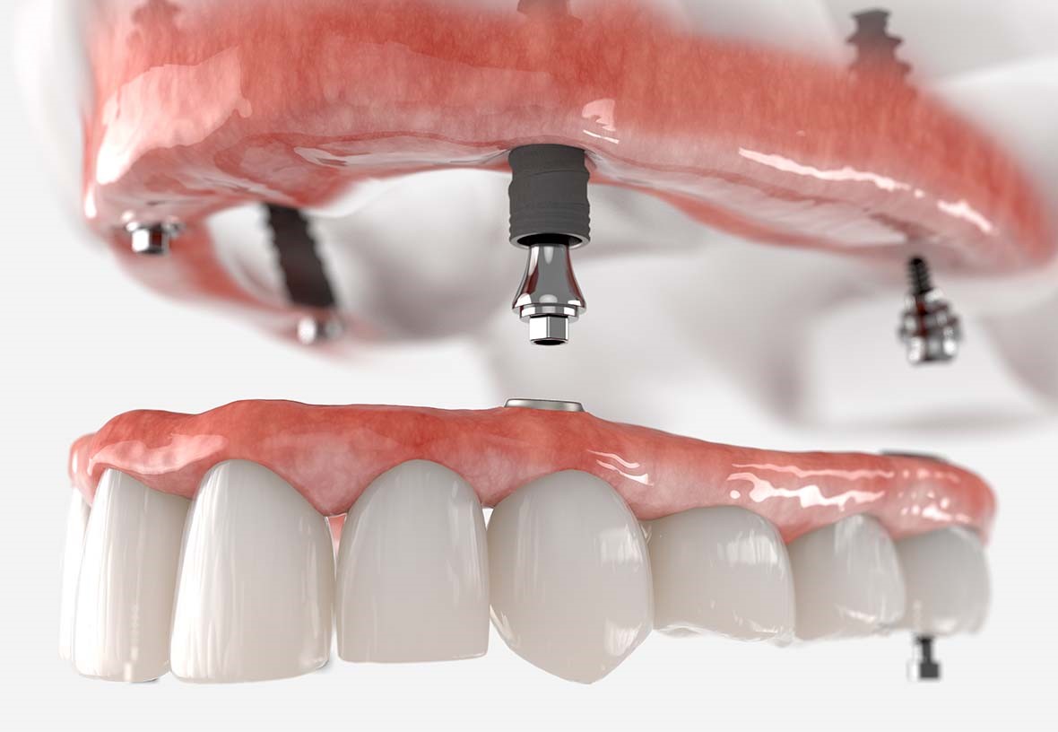 implant supported dentures