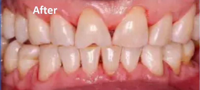 teeth cleaning after