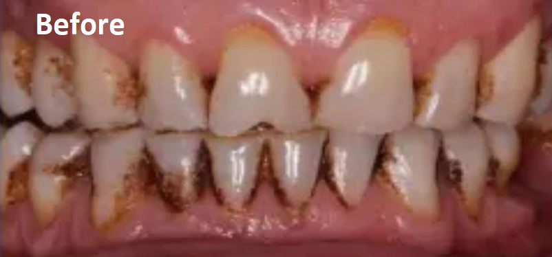 teeth cleaning before