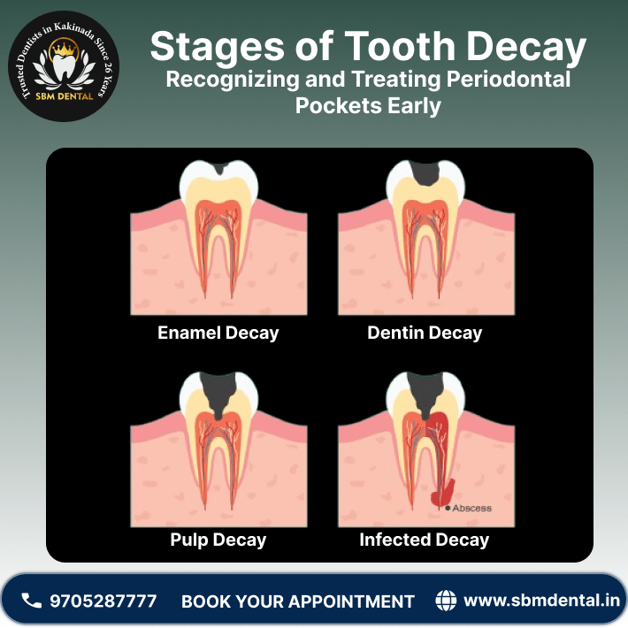 tooth decay stages