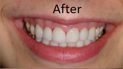 after laser dentistry