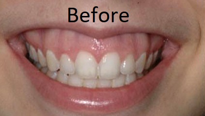 before laser dentistry