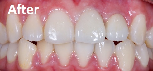 crowns after