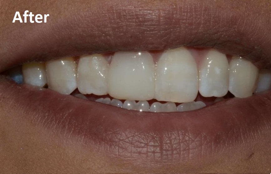 crowns and bridge after