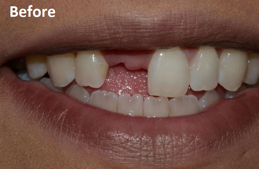 crowns and bridge before