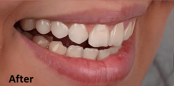 dentures after treatment