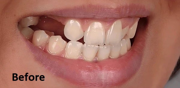 dentures before treatment