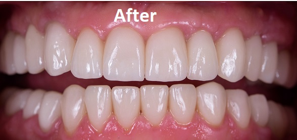 dentures treatment after