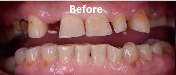 dentures treatment before