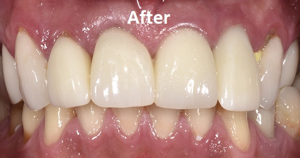 guided dental implant after