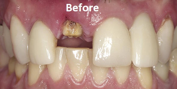 guided dental implant before