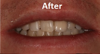 guided implant after