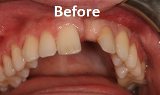 guided implant before