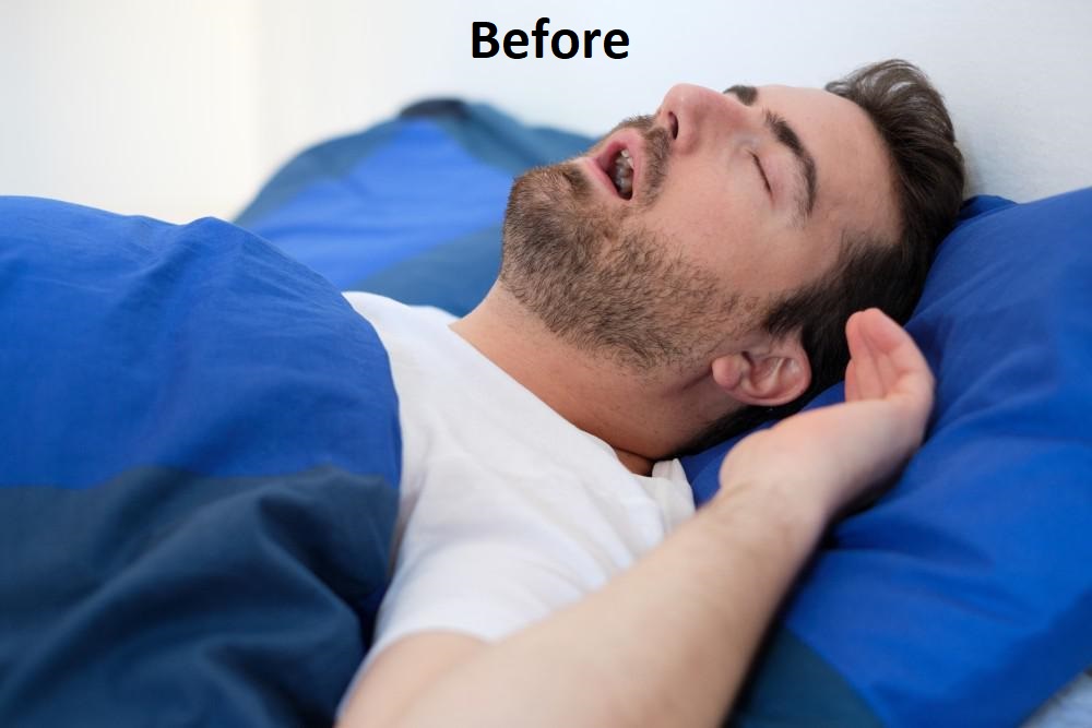 sleep apnea before treatment