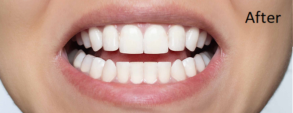 smile design - after