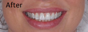 smile design - after