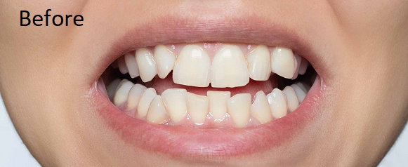 smile design - before 2