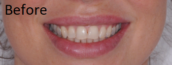 smile design - before