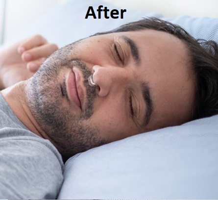 snoring sleep after treatment