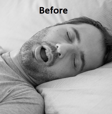 snoring sleep before treatment