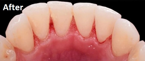 teeth whitening after treatment
