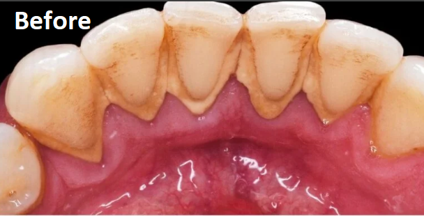 teeth whitening before treatment