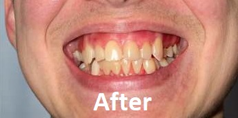 wisdom teeth removal after