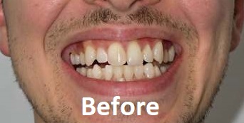 wisdom teeth removal before