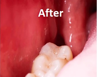 wisdom tooth removal after