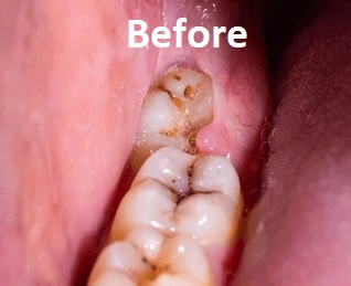 wisdom tooth removal before
