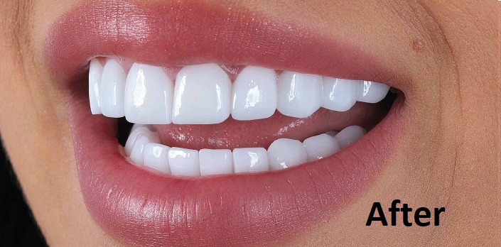 zirconia crowns after treatment