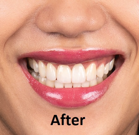 zirconia crowns after
