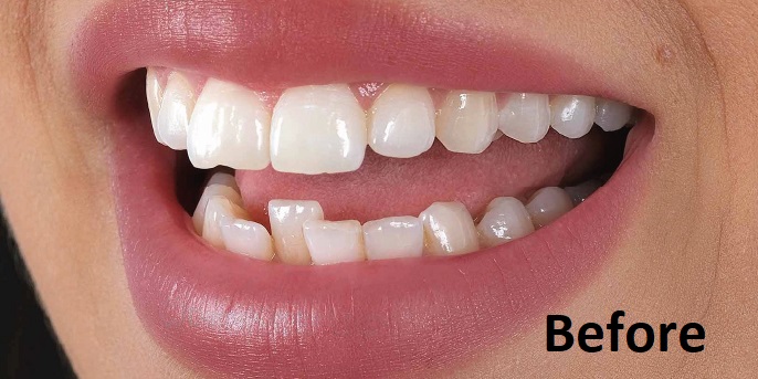 zirconia crowns before treatment