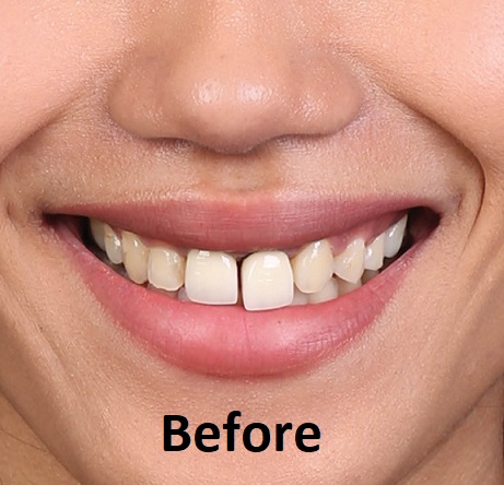zirconia crowns before