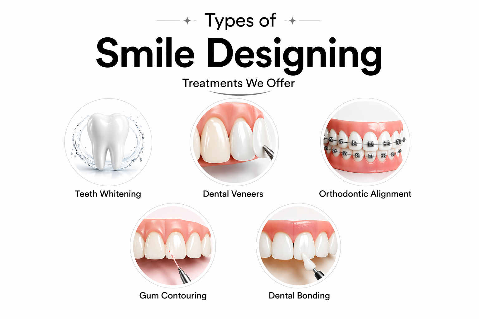 Types of smile designing